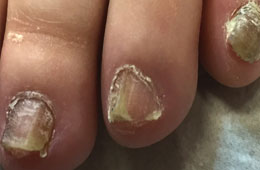 Fungal nail infection
