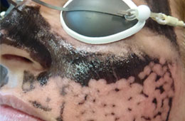 Hollywood Peel