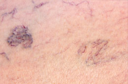 blood vessels and thread veins