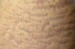 Stretch Marks and other scars
