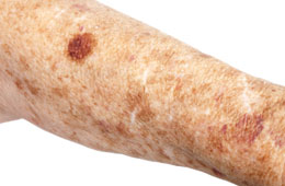 pigment, brown spots, age spots, freckles