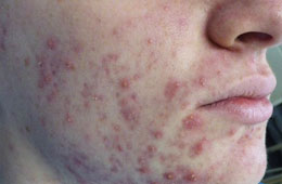 acne and acne scar reductions