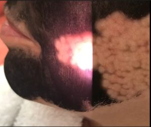 The Hollywood Peel skin rejuvenation treatment