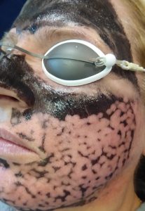 a Hollywood Peel skin rejuvenation session